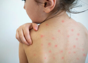 Emite Salud alerta por sarampión importado