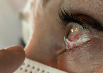 Pese a ser una de las entidades con más casos, descartan brote de conjuntivitis en Tamaulipas. Foto de Ocumed