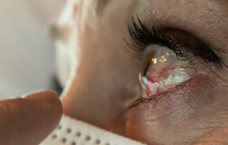 Pese a ser una de las entidades con más casos, descartan brote de conjuntivitis en Tamaulipas. Foto de Ocumed