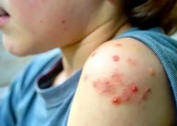 México registra 809 casos de tos ferina y 583 de sarampión