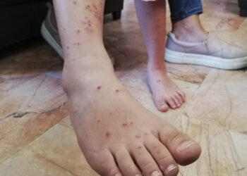 Tamaulipas cuarta entidad con más casos de varicela en el país. Foto de Comunicación Social de Oaxaca