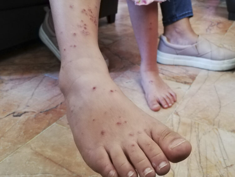 Tamaulipas cuarta entidad con más casos de varicela en el país. Foto de Comunicación Social de Oaxaca