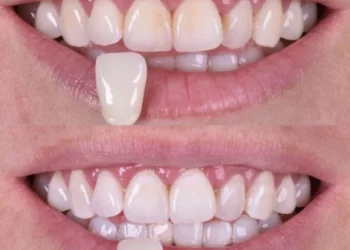 Blanqueamiento dental en Puebla: consigue una sonrisa más blanca con WeDenth