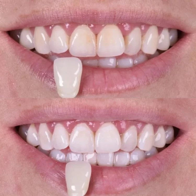 Blanqueamiento dental en Puebla: consigue una sonrisa más blanca con WeDenth