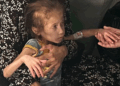 Foto de niña en Gaza con desnutrición severa. Imagen: @UNOCHA:Olga Cherevko