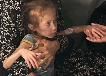 Foto de niña en Gaza con desnutrición severa. Imagen: @UNOCHA:Olga Cherevko