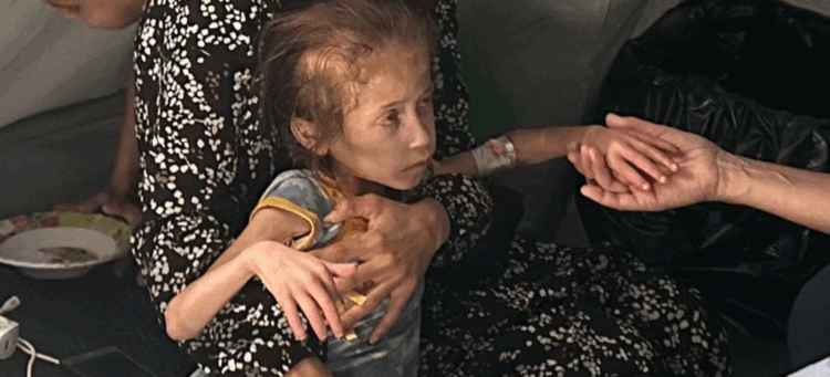 Foto de niña en Gaza con desnutrición severa. Imagen: @UNOCHA:Olga Cherevko