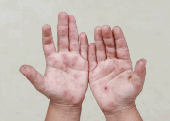 Tamaulipas registra 128 casos del virus Coxsackie. Foto de Web