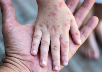 Sarampión está contenido en Tamaulipas; sólo investigan dos probables casos. Foto de UNAM